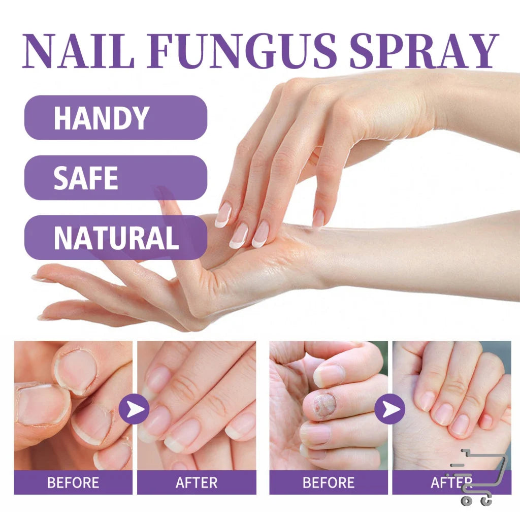 Nail Repair Spray with Thyme and Peppermint Oil shows before and after nail fungus treatment