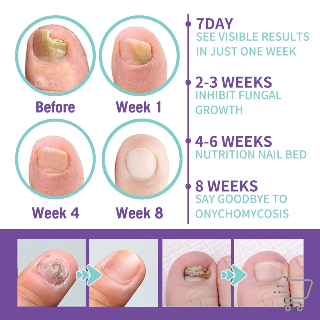 Progression of toenail fungus treatment using Nail Repair Spray with Thyme and Peppermint Oil