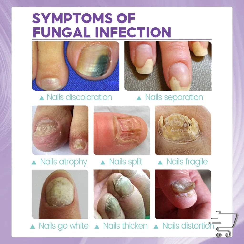 Visual guide of fungal nail infection symptoms with 100ml Nail Repair Spray featured